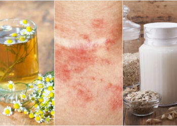 Aceites naturales para curar el eczema