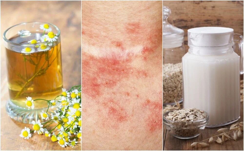 Aceites naturales para curar el eczema